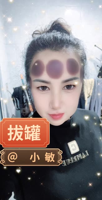 女人拔脑门火罐故事图片